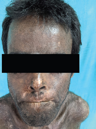 Clinical photograph demonstrating mutilating scars over the face.